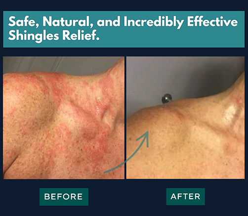 Safe and Effective Shingles Relief